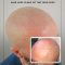 Can I still shave my head after getting scalp micropigmentation